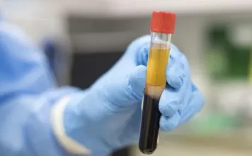 Plasma Therapy